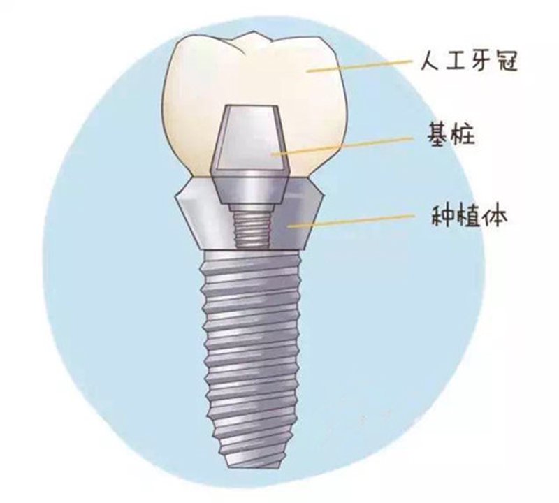 探索牙齿健康的深层清洁之道——洗牙不容忽视